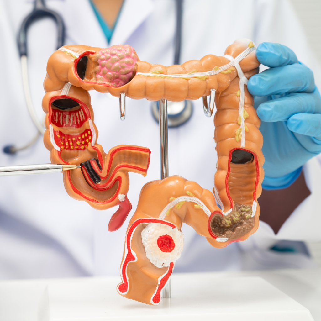 Žolelės nuo dirgliosios žarnos sindromo