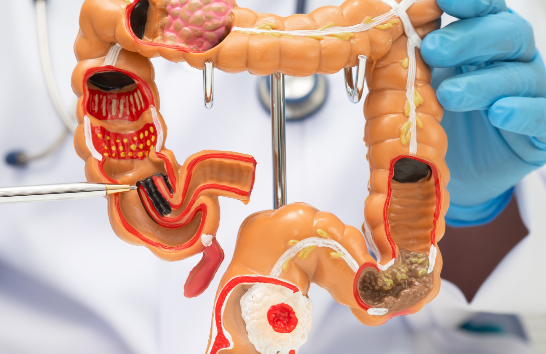 Žolelės nuo dirgliosios žarnos sindromo: natūralūs būdai palengvinti simptomus 1 Žolelės nuo dirgliosios žarnos sindromo