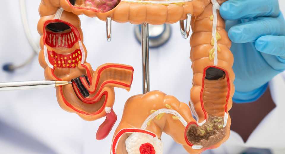 Žolelės nuo dirgliosios žarnos sindromo